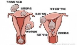 有子宫肌瘤可以吃凉瓜,助调养身体